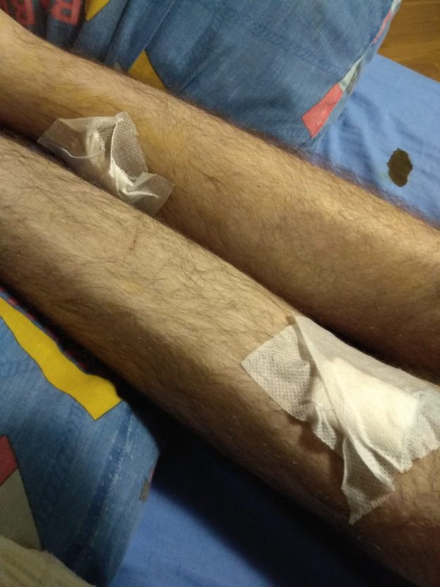 Heridas curadas por un tetrapléjico